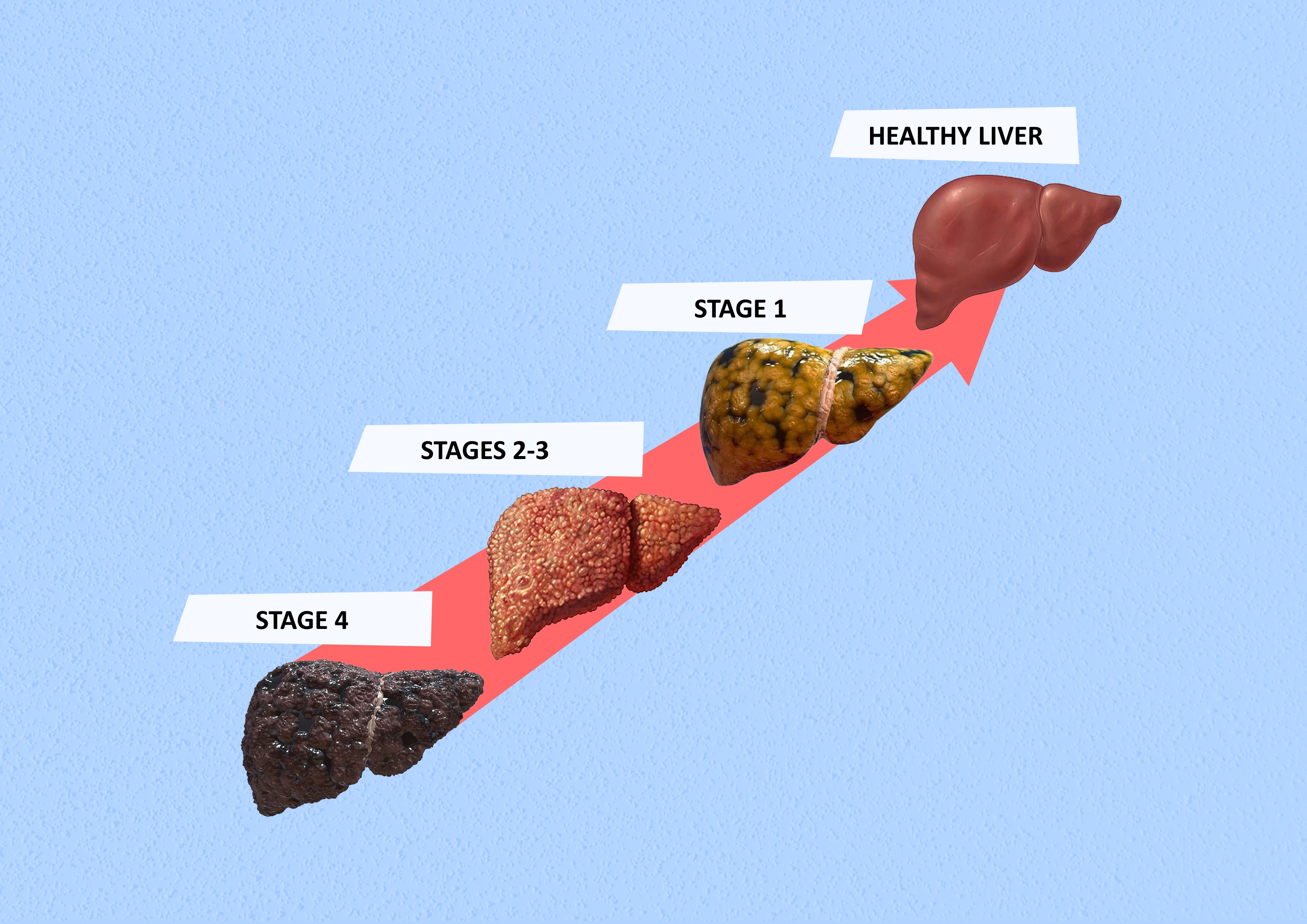 STAGES OF FIBROSIS